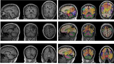 Radiology_AI's tweet image. 💡 Revolutionizing neuroimaging: DLMUSE segments brain MRIs in seconds, enabling large-scale studies without the need for complex setups -- Dive into the future of brain research! doi.org/10.1148/ryai.2… @Penn #MRI #DeepLearning #segmentation