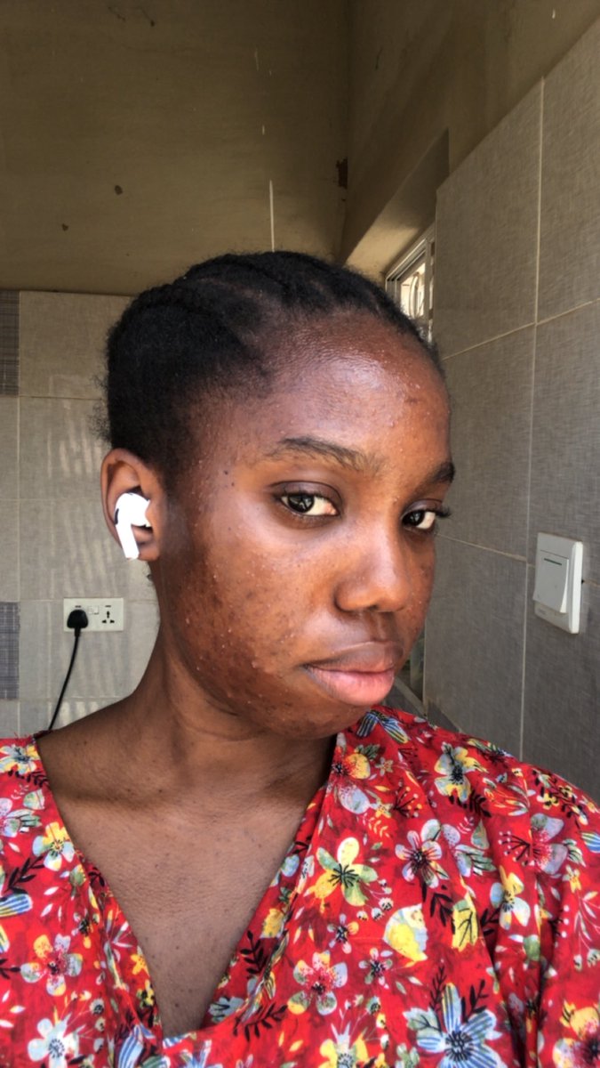 maayokun's tweet image. i defeated acne 🙏🏾