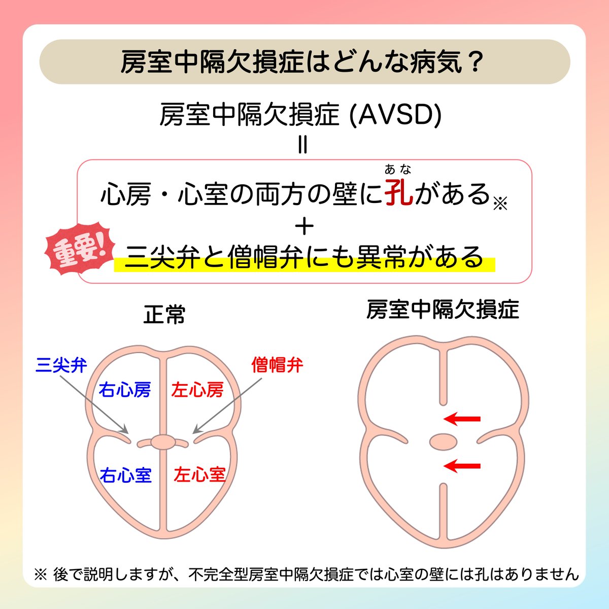 JSPCCS's tweet image. 日本小児循環器学会です😊
 
❤️ 子どもの心臓病の解説 ❤️
 
 ＼房室中隔欠損症／
 
以前は「心内膜床欠損症(ECD)」と呼んでいましたが、
最近は世界的に「房室中隔欠損症(AVSD)」と呼ぶようになりました。

そして、重要なことは….房室中隔欠損症は、
心房中隔欠損症(ASD)＋心室中隔欠損症(VSD)…
