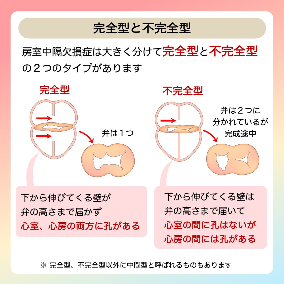JSPCCS's tweet image. 日本小児循環器学会です😊
 
❤️ 子どもの心臓病の解説 ❤️
 
 ＼房室中隔欠損症／
 
以前は「心内膜床欠損症(ECD)」と呼んでいましたが、
最近は世界的に「房室中隔欠損症(AVSD)」と呼ぶようになりました。

そして、重要なことは….房室中隔欠損症は、
心房中隔欠損症(ASD)＋心室中隔欠損症(VSD)…