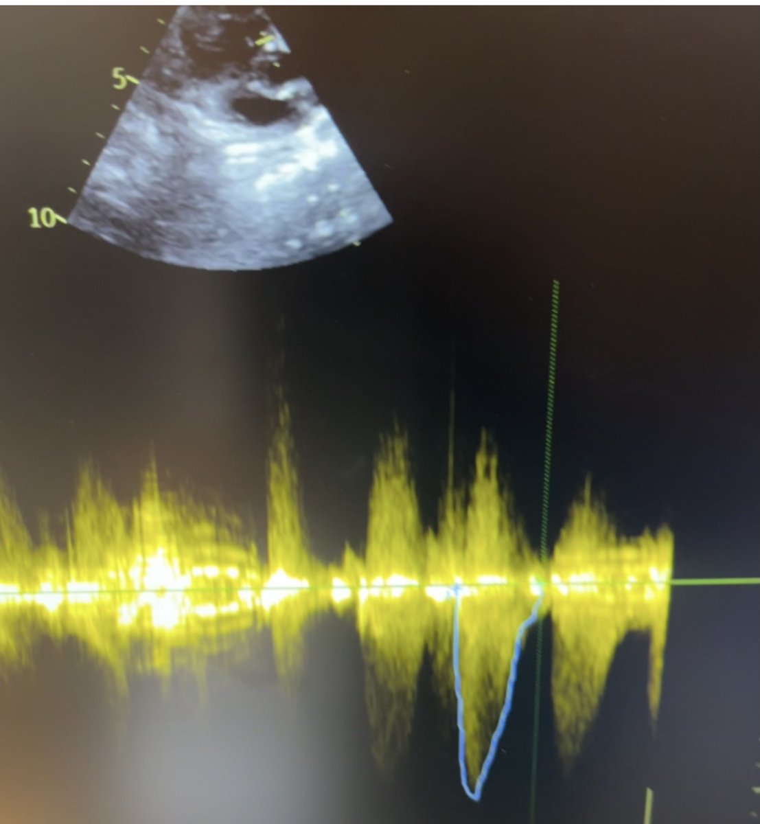 baramink's tweet image. 2 mo old boy with systolic murmur. 

Dx ? 

#Echofirst 
#Cardiology 
#CardioEd