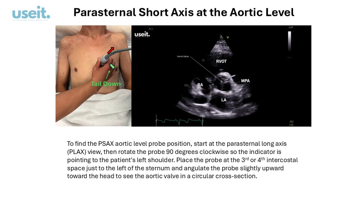 pocus_today's tweet image. PSAX Aortic Level
#useit
#POCUS
