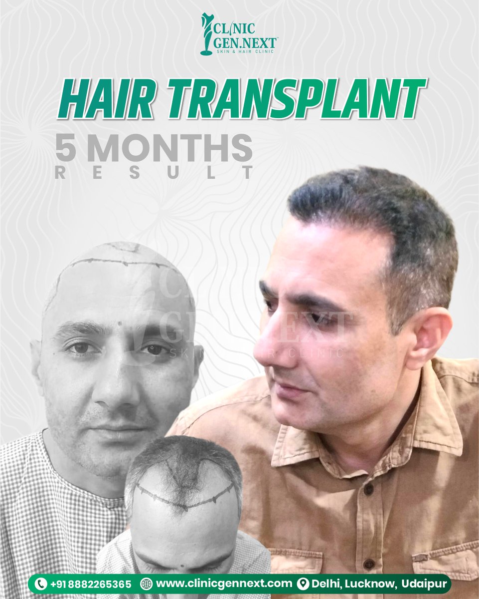 clinicgennext's tweet image. Another powerful 5-month hair transplant transformation at ClinicGenNext! 💼✨

#DrKunal #DrKunalSingh #ClinicGenNext #BestHairTransplantClinicInIndia #HairTransplantDelhi #HairTransplantLucknow #HairTransplantUdaipur #FUEHairTransplant #HairRestoration #HairClinicIndia