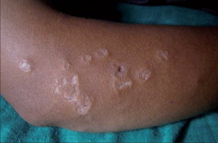 IlliasulK's tweet image. Lupus patient with this skin lesion… what’s your diagnosis?

👇 Comment your answer — let’s see how sharp your eyes are.

#DermTwitter #MedTwitter #RheumTwitter #SkinQuiz #Lupus #SpotTheDiagnosis #MedicalMystery #FOAMed #IMResidents #Dermatology
@DrAkhilX @IhabFathiSulima