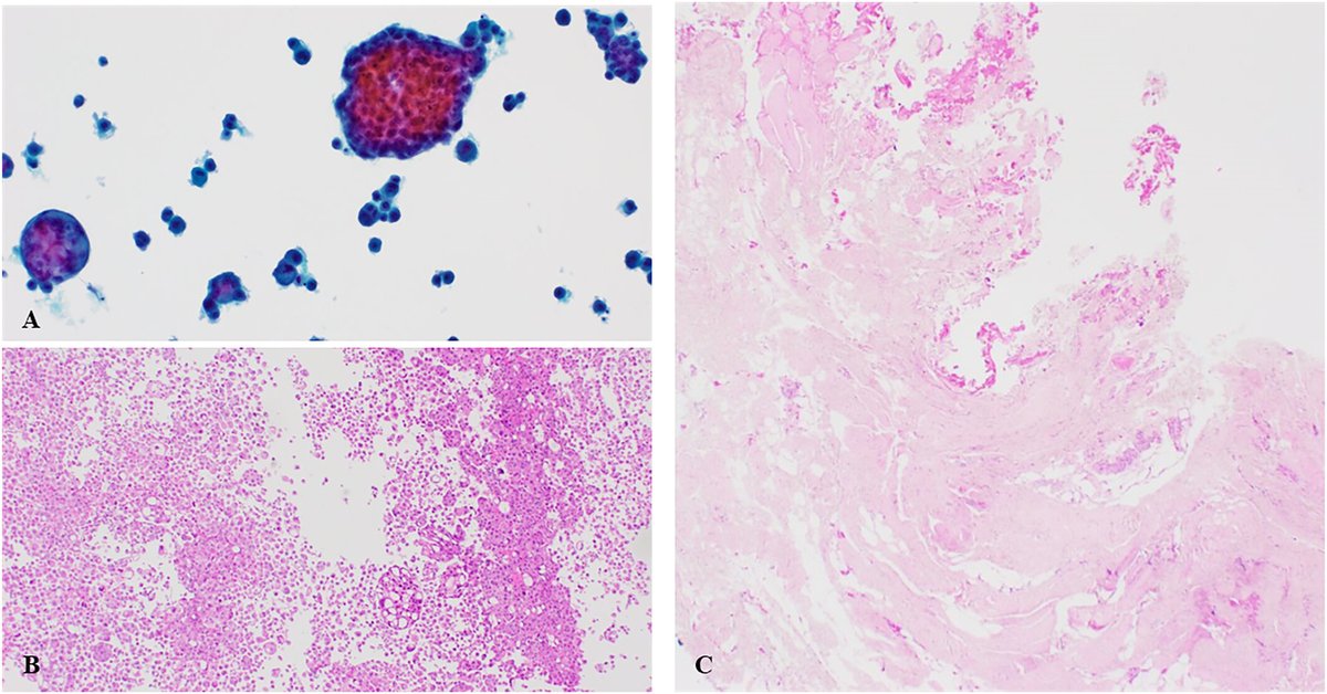 CancerCytopath's tweet image. This study examines pericardial fluid evaluation, comparing cytology vs. surgical specimens for malignancy detection. Findings highlight diagnostic yield of cytology. 

acsjournals.onlinelibrary.wiley.com/doi/full/10.10…

@drElieTannous #CytoPath