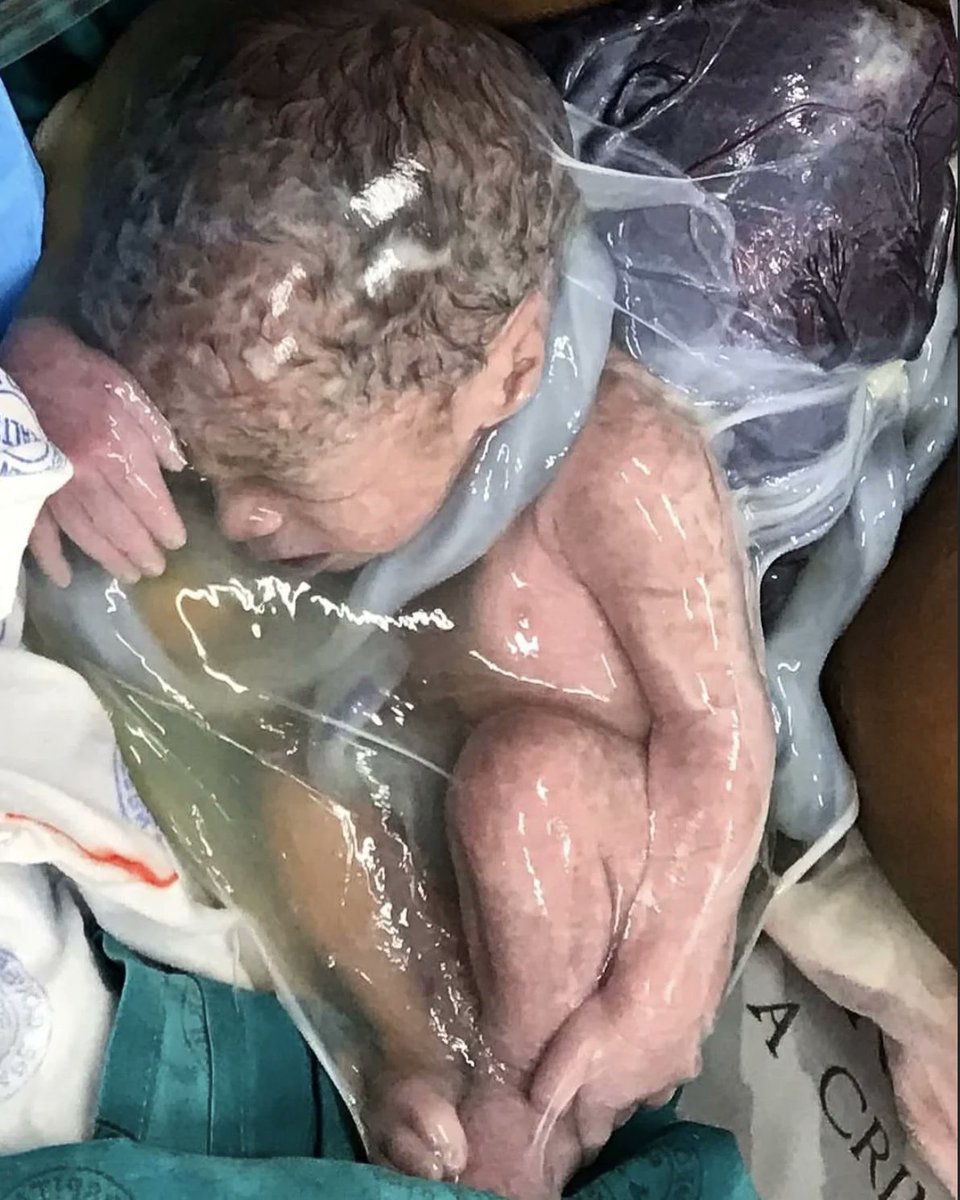 codmantriangle's tweet photo. En caul delivery — this newborn arrives in its protective amniotic sac. #MedTwitter https://t.co/IyPXOl7klV