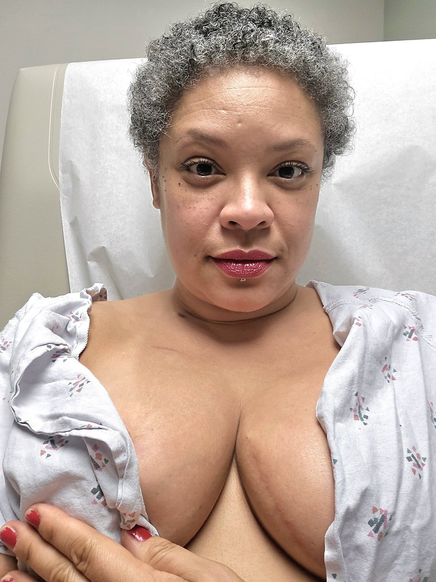 FuckingTracey's tweet image. I may be having a hard time losing this weight, but my hair is growing back so fast and I&apos;m still cute than a mutha!  Hahahaha #BreastCancerAwareness #FridayVibes #healthcare