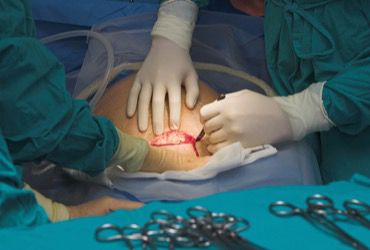 anesthesianews's tweet image. Persistent pain after cesarean delivery affects more than 2% of patients — and new national data reveal key risk factors clinicians should know anesthesiologynews.com/a/KDIBAA/t #Anesthesiology #MedTwitter #Csection
