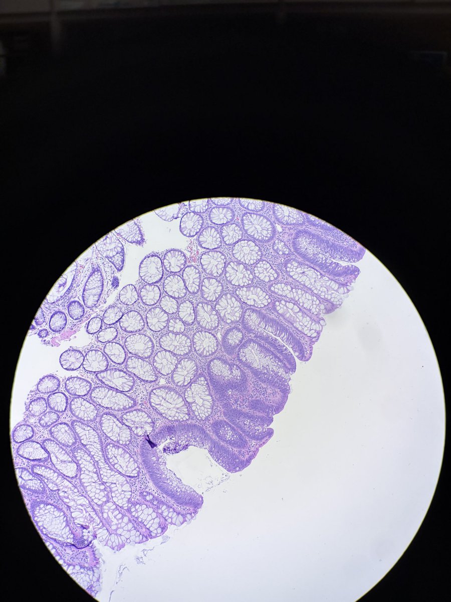 PathServerUS's tweet image. Yesterday, I was told something which struck me:

“Whenever you find the basic lesion, look for the next higher grade lesion”

Btw this is Tubular Adenoma