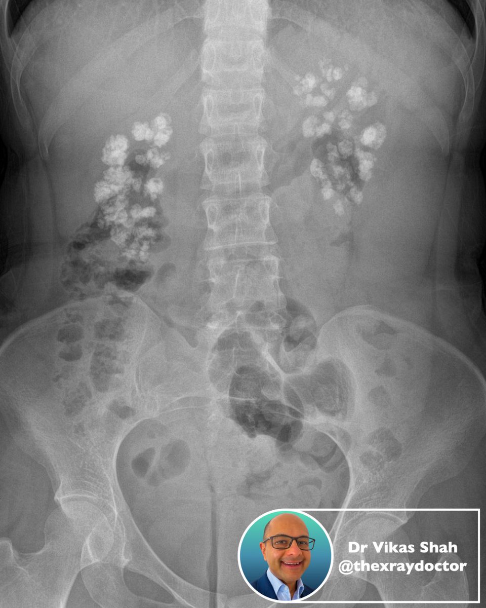 ⏰ Quiz time!

🩻 What is the main abnormality, and what are the causes?

#radiology #FOAMed