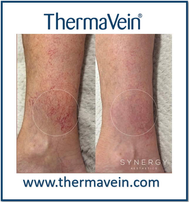 'Tis the season to treat thread veins. ThermaVein is the safe ...