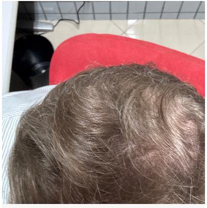 1 ano de tratamento com Manual e minha careca sumiu. Quem quiser 40% desconto aí vale a pena manual.com.br/referral-link?…