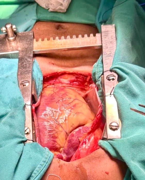 Ventrículo derecho dilatado, hipertensión pulmonar severa, Comunicacion interauricular #atrialseptaldefect
