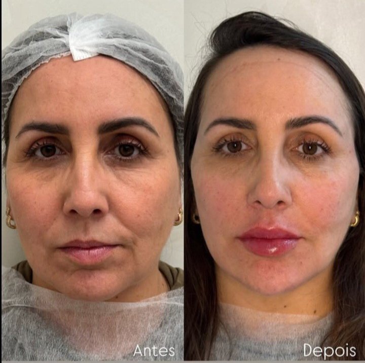 chrisinhac's tweet image. Em meio às aberrações por aí.... lá vai um antes e depois c mta naturalidade