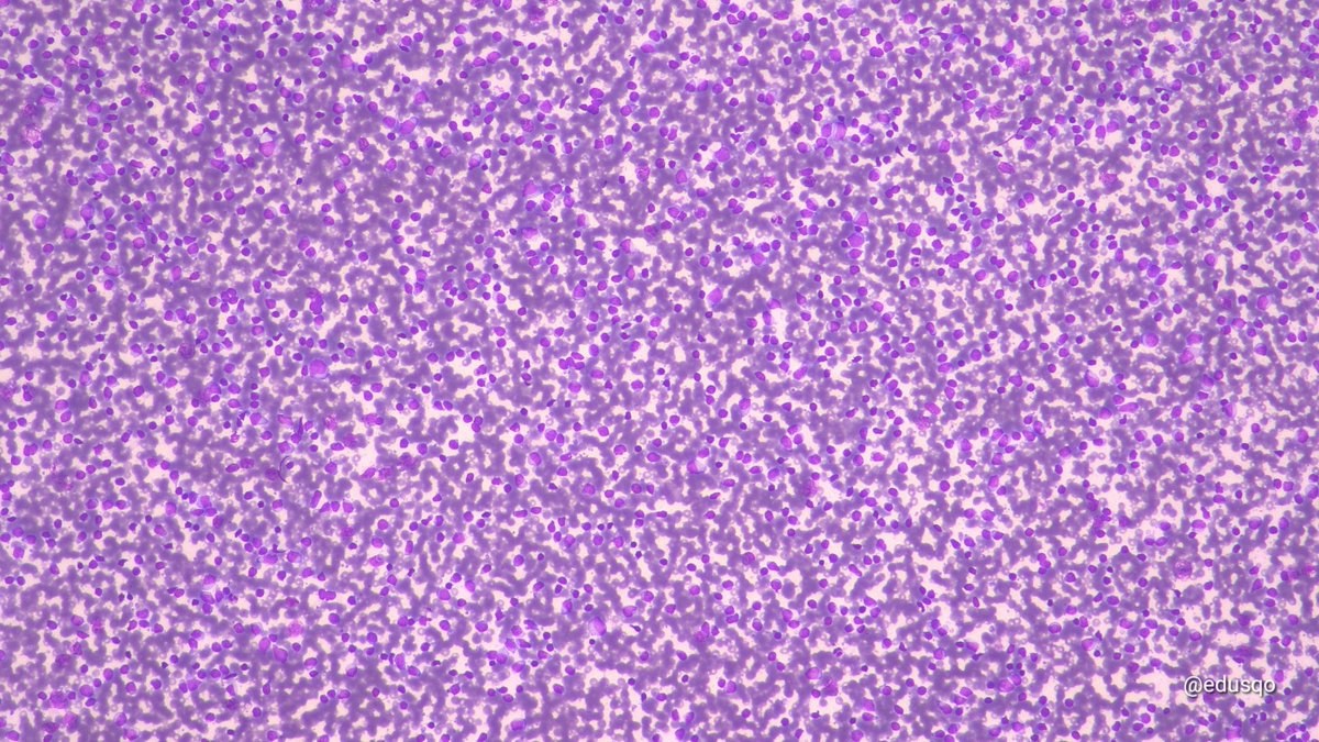 edusqo's tweet image. I love Cytospin for some #HemePath #CytoPath scenarios and even more when #IHCPath results are so usefull.
Small lymphocytic lymphoma. 
#IHCPath in the #CellBlock was also performed  #FNAFriday