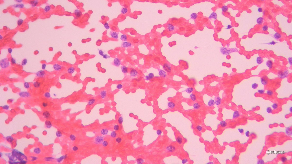 edusqo's tweet image. I love Cytospin for some #HemePath #CytoPath scenarios and even more when #IHCPath results are so usefull.
Small lymphocytic lymphoma. 
#IHCPath in the #CellBlock was also performed  #FNAFriday