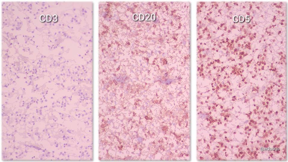 edusqo's tweet image. I love Cytospin for some #HemePath #CytoPath scenarios and even more when #IHCPath results are so usefull.
Small lymphocytic lymphoma. 
#IHCPath in the #CellBlock was also performed  #FNAFriday