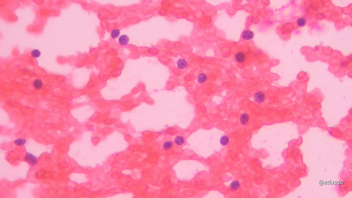 edusqo's tweet image. I love Cytospin for some #HemePath #CytoPath scenarios and even more when #IHCPath results are so usefull.
Small lymphocytic lymphoma. 
#IHCPath in the #CellBlock was also performed  #FNAFriday