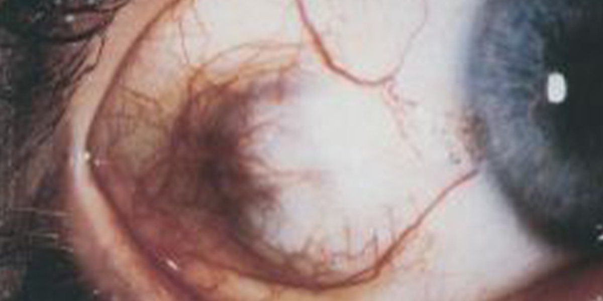 eyewiki's tweet photo. Intraocular #leiomyoma is an uncommon benign smooth muscle tumor that can originate from the #ciliary body. Keep it in the differential of a ciliary body #melanoma.  #aao #ophthalmology https://t.co/q1weUaN5Xd https://t.co/K84qltaMQz