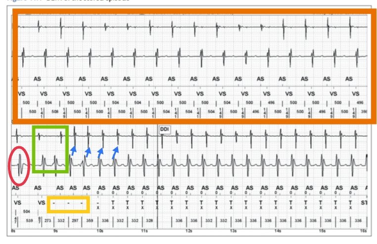 Frances98392343's tweet image. 3) An initial V&amp;gt; A ratio can be observed 🟢
4)The tachycardia later has a 1:1 A/V ratio due to retrograde VA conduction 🔵
5) The morphology discrimination algorithm indicates 0% resemblance  with the stored EGM template in SR, which is below the match threshold