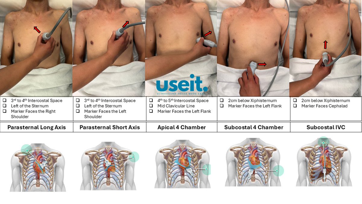 #POCUS #useit
Focused Cardiac Ultrasound Views