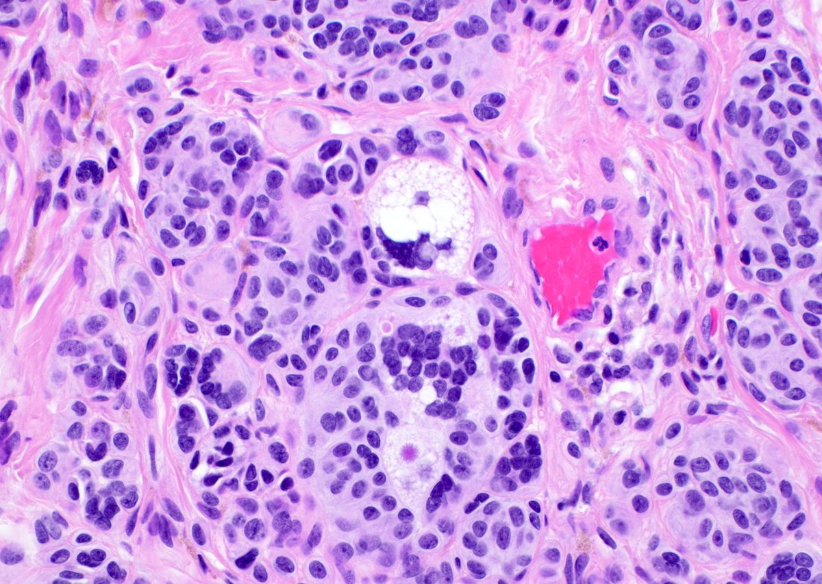 JMGardnerMD's tweet image. What are the bubbly cells? (hint: they&apos;re NOT sebocytes or lipoblasts!) 
What is the pink dot in the cytoplasm? Diagnosis?
Answers ✅ youtu.be/DqLK6ZvNXTU 
#pathology #pathologists #pathTwitter #dermpath #dermatology #dermatologia #dermtwitter