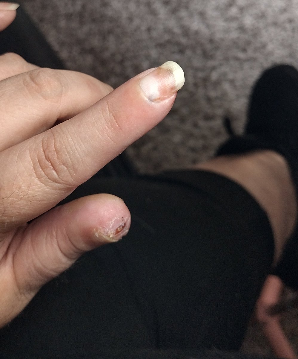 I picked up my guitar for the first time since my accident. I can't play it like before and that makes me real fucking sad. 😒