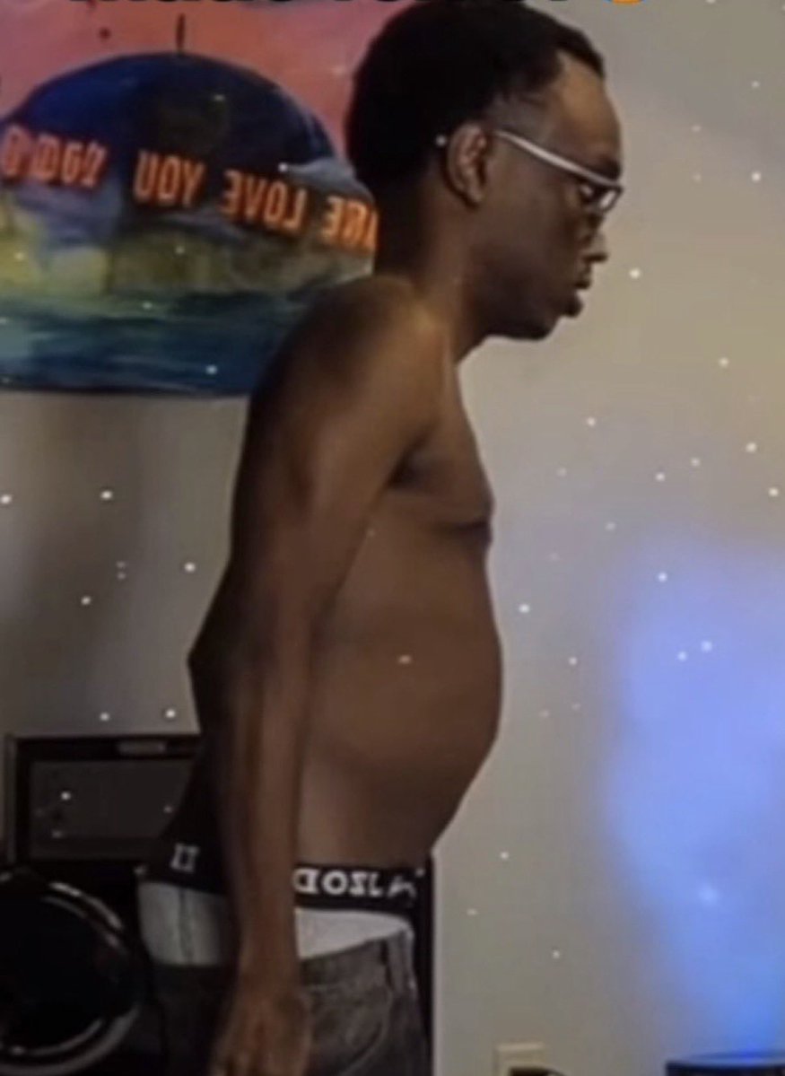 Yusuf7nreports's tweet image. Streamer Yusuf7n shows off his side profile improvement after over a year of hard work 🔥 👀