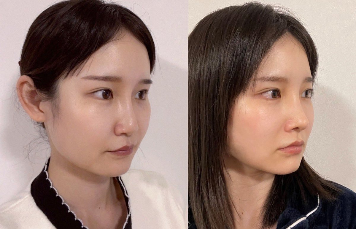 Quinn_ppp's tweet photo. @zerooneps163756
ゼロワン美容整形外科で鼻の整形してきた◎
2回目だったので不安だったけど
dt2週間で腫れもひいてめっちゃ良い感じで満足！鼻根もう少し腫れひいて完成まで楽しみ🫶🏻

#鼻整形 #韓国 https://t.co/dnTibfMimQ