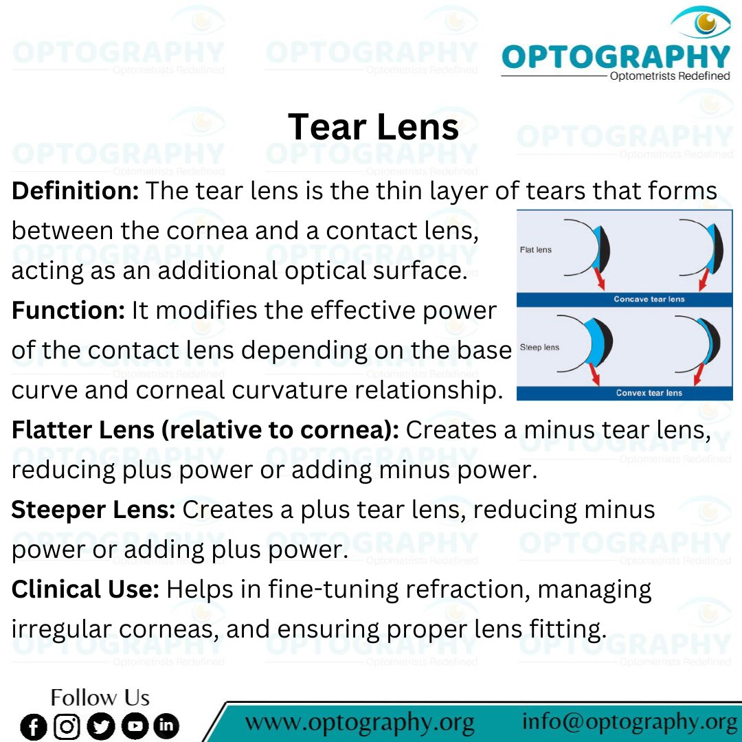 Optography8's tweet image. The tear lens may be invisible, but its role is powerful.
It fine-tunes your vision with every blink.
Small layer, big optical impact.
#Tearlens #Contactlens #Concave_convex #Optometry #Optography #Thatoptometrist