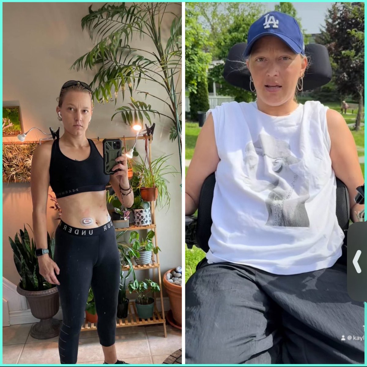 kcpollock's tweet image. 🕊️ I’m using trial by jury against Moderna in a $45 million lawsuit holding them accountable for paralyzing me. I’m fighting for medical freedom, transparency, and justice for all who were harmed.

I was offered Medical Assistance in Dying (MAID) instead of care. I know I’m not…