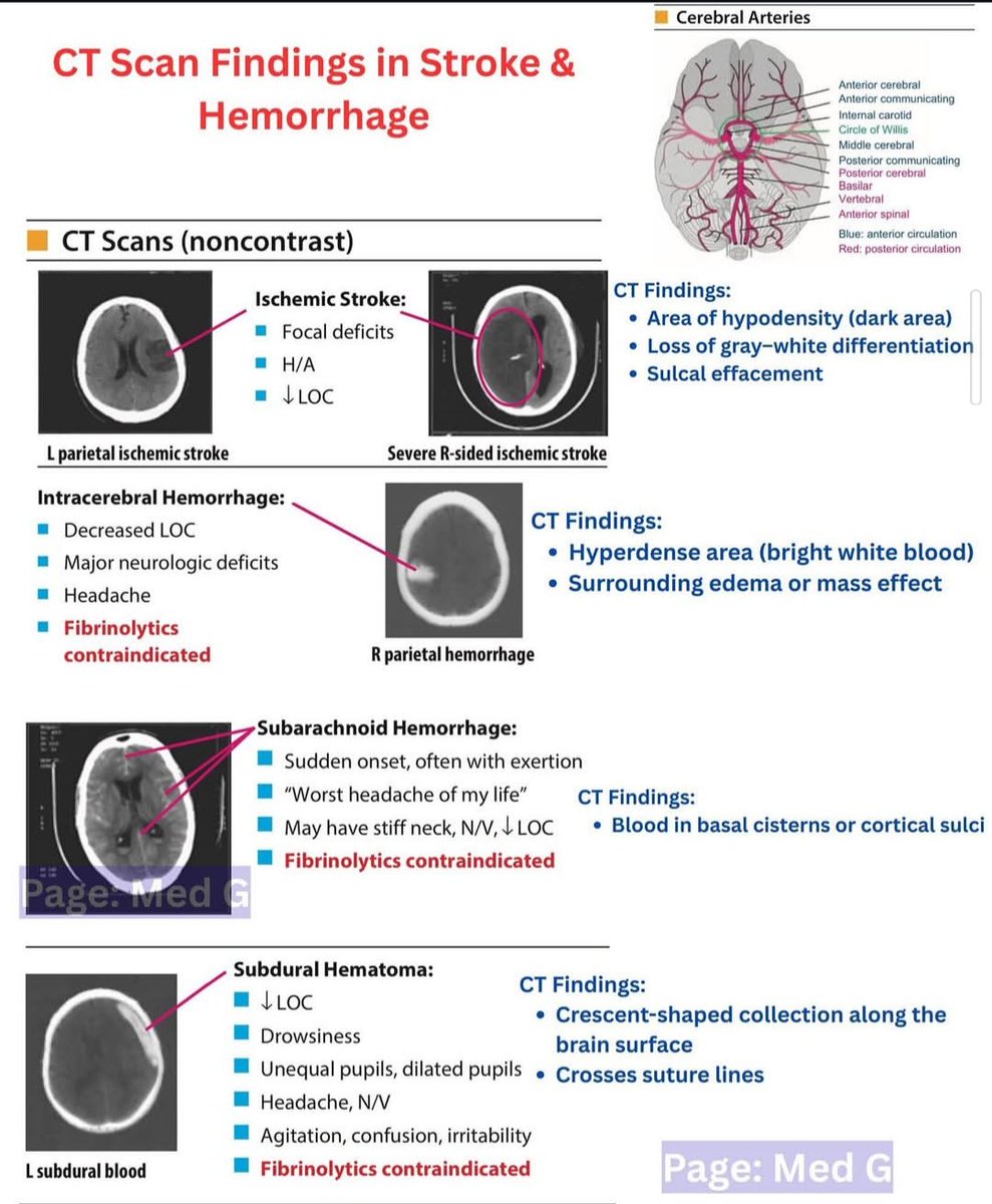 CT findings in STROKE