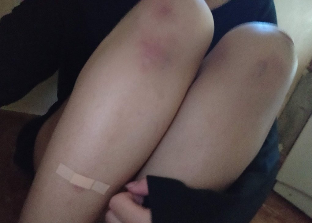 Nausik4's tweet photo. Never posted myself before but I guess I'll give it a try 🫣
-
-
-
-
-
-
-
#nsfwtwt #nsfw #softnsfw #cute #body #bruisetwt #bruise https://t.co/h5pB2aBnKc
