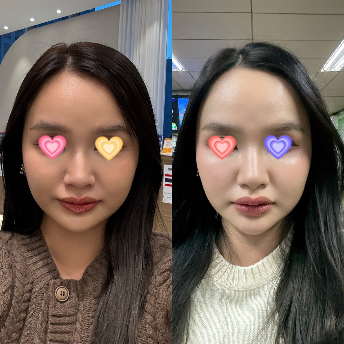 maybeitscms's tweet image. [Thread] รีวิวคลินิก + หัตถการที่ทำที่เกาหลี

คือทำมา 3 ครั้งละ ที่เดิม บ่อยกว่าที่ไทยอีก เพราะที่ไทยชอบเปลี่ยนคลินิก แต่มาเกาหลีชั้นเดินเข้า dr.evers  เลย มีล่ามคนไทย บริการดี ราคาถูกที่สุดเท่าที่เทียบมาหลาบๆเจ้า และหมอทำหัตการเอง (บางเจ้าที่ไทยเจอให้พนงทำ