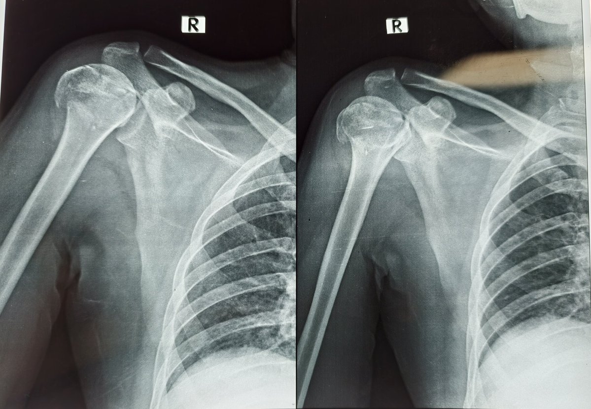 wizofbones's tweet image. Tried Gemini 3 and it also failed to interpret a simple xray.

So far, chatgpt, grok and Gemini have failed to diagnose this simple xray