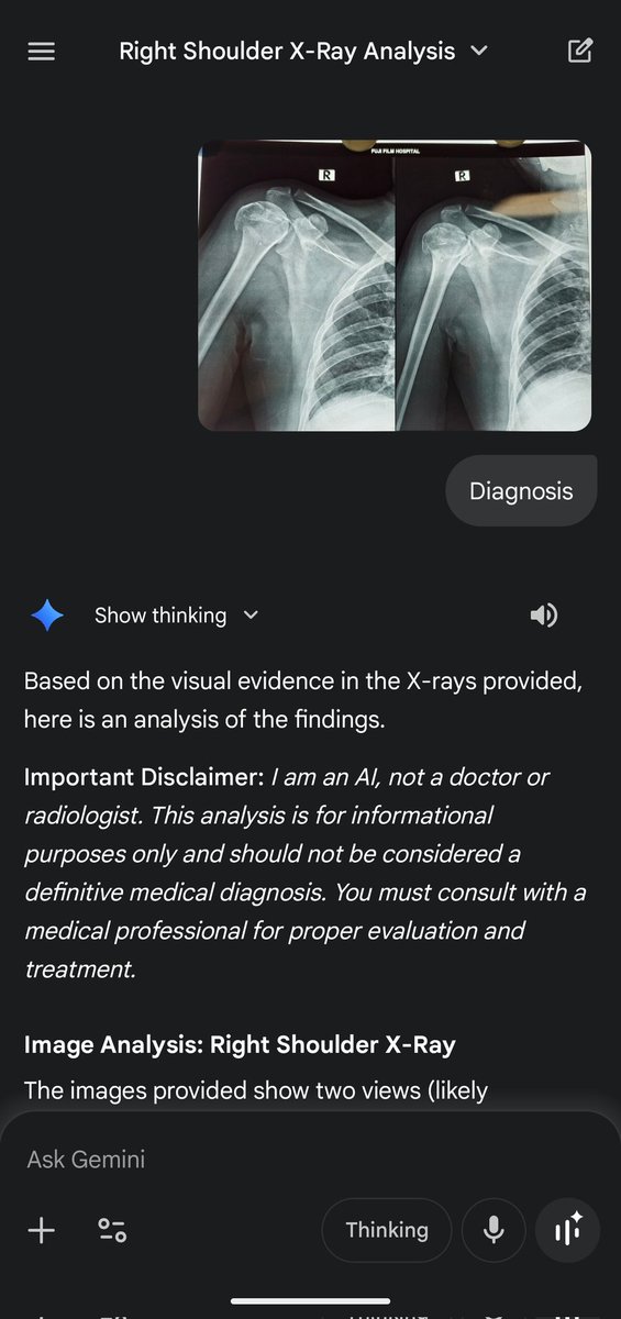 wizofbones's tweet image. Tried Gemini 3 and it also failed to interpret a simple xray.

So far, chatgpt, grok and Gemini have failed to diagnose this simple xray