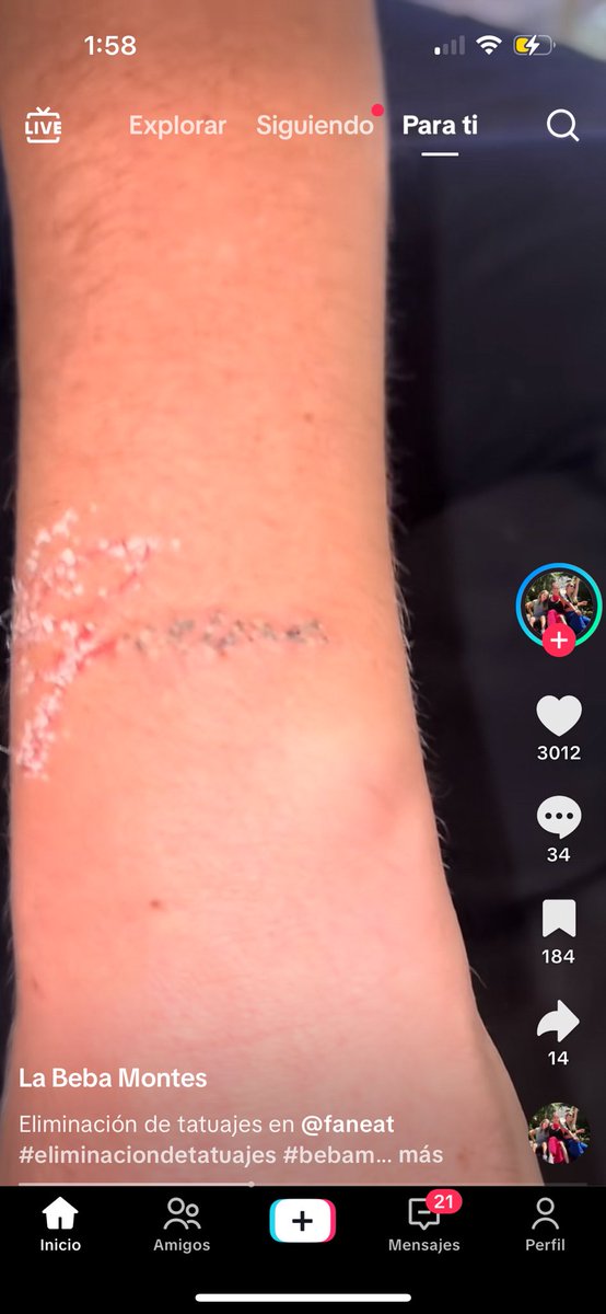 Nuestra beba  se quito el tatuaje del Garime noooooooo “el Garime es un todo” ( Falso)  “el Garime va mas allá“( solo para monetizar)  “El Garime amamos“( no amaron nada solo son pendejos  que les vieron  la cara)  no cabe duda que las Montes son la peor caca del espectáculo.