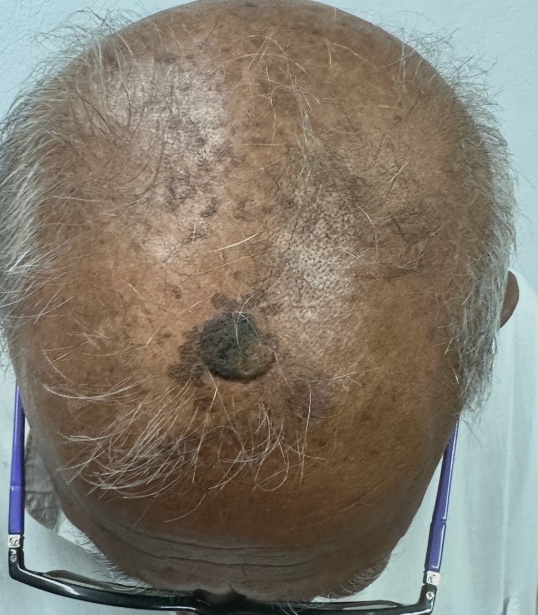 docpiyush's tweet photo. Seborrheic keratosis- treated with Urea 40% &amp; moisturiser. Result after 3 months. During Rx, 2 episodes of erosions requiring transient stopping Urea 40 &amp; administration of topical antibiotics. 

#MedTwitter 
#dermtwitter https://t.co/m7ViBnSKRN