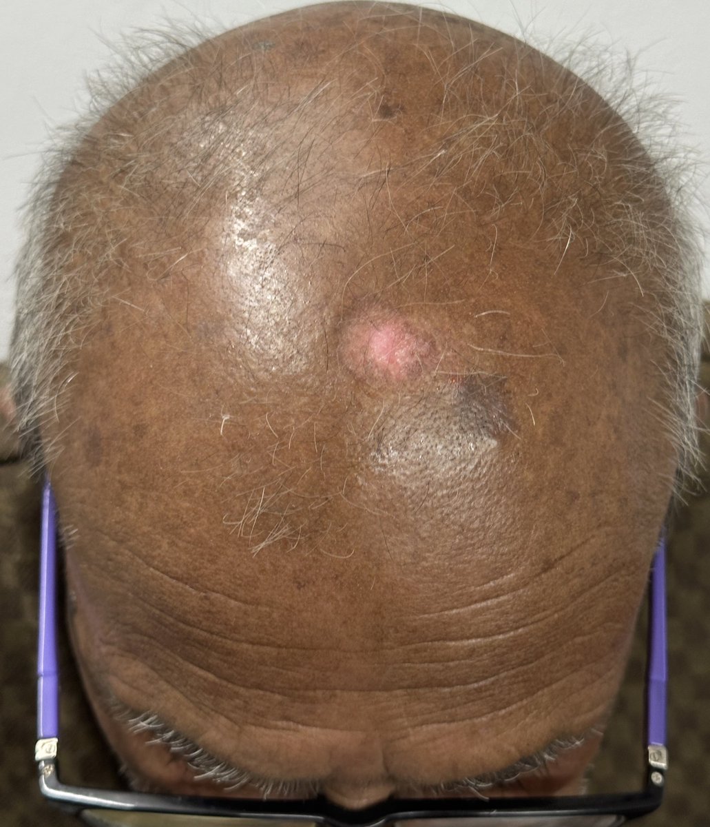 docpiyush's tweet photo. Seborrheic keratosis- treated with Urea 40% &amp; moisturiser. Result after 3 months. During Rx, 2 episodes of erosions requiring transient stopping Urea 40 &amp; administration of topical antibiotics. 

#MedTwitter 
#dermtwitter https://t.co/m7ViBnSKRN
