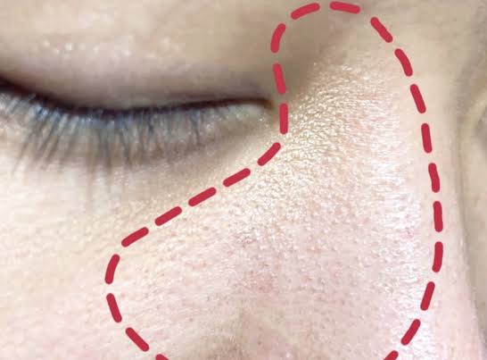 え、やっぱりそうだよね！？！？この美容液使い出してから毛孔性角化症(チキンスキン)ガチでなくなった。