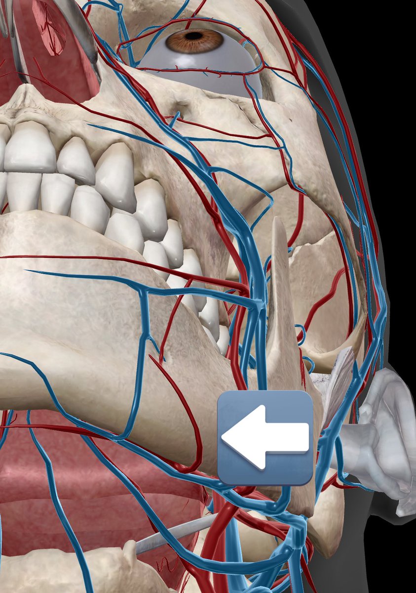 dr_nobutomi's tweet image. この方の様に、多くの人が誤解しているので整理して解説します。

脂肪吸引後に“命に関わる血腫”として問題になるのは、
顔面動脈の枝（特にオトガイ下動脈）からの“動脈性出血” です。
これは一気に血が溜まるため、場合によっては挿管が困難になります。…