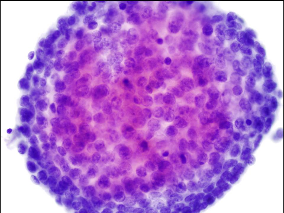 smlungpathguy's tweet image. Dear cyto friends, are cannonballs in pleural fluid a helpful clue? How? Please educate us!

#pathology #cytopath