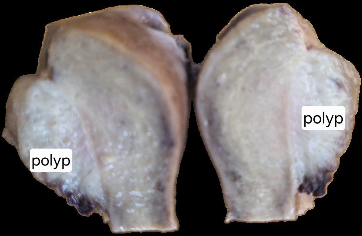 pathphyo's tweet photo. A large sessile endometrial polyp (4 cm) in a 47 years old lady presenting with heavy perimenopausal bleeding. Relieving benign diagnosis for the patient.
#pathology #gynepath #endometrial_polyp #benign https://t.co/WGM5679zaK
