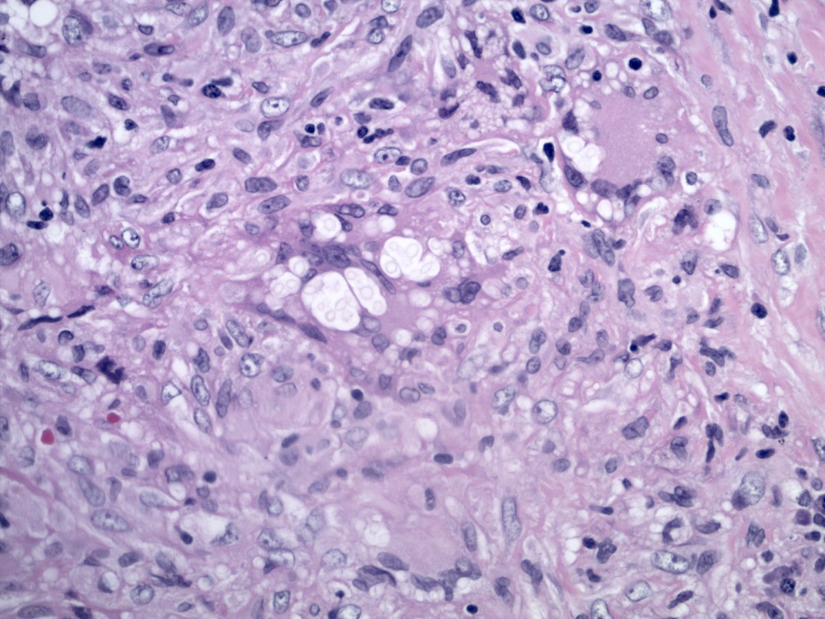 smlungpathguy's tweet image. 219/
I am always amazed by the power of the H&amp;amp;E stain. Much reviled over the years, it remains the backbone of pathologic diagnosis all over the world. It&apos;s often all you need to identify Cryptococcus

#tweetcyclopedia