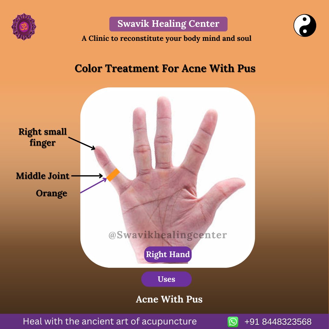 SwavikHealing's tweet image. ✨ Color Treatment for Acne With Pus

Acne with pus (pustule) is an inflammatory acne with a white/yellow head.
Apply orange color on the middle joint of the right small finger to support healing naturally.

#AcneCare #Pustule #NaturalHealing #ColorTherapy #AcupunctureHealing
