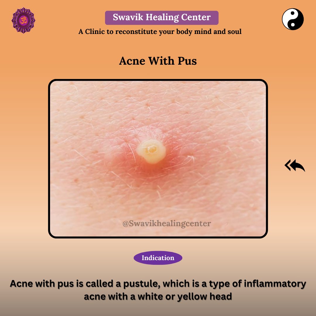SwavikHealing's tweet image. ✨ Color Treatment for Acne With Pus

Acne with pus (pustule) is an inflammatory acne with a white/yellow head.
Apply orange color on the middle joint of the right small finger to support healing naturally.

#AcneCare #Pustule #NaturalHealing #ColorTherapy #AcupunctureHealing