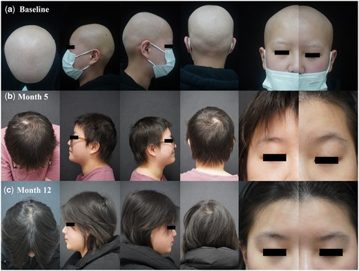 plainyogurt21's tweet image. pubmed.ncbi.nlm.nih.gov/41002258/
$NKTR
&quot;Four refractory AA patients (median follow-up: 32.5 months) with complete hair regrowth (SALT = 0) after ≥6 months of tofacitinib received adjunctive IL-2. Three patients maintained complete remission for 11-20 months after treatment cessation,…