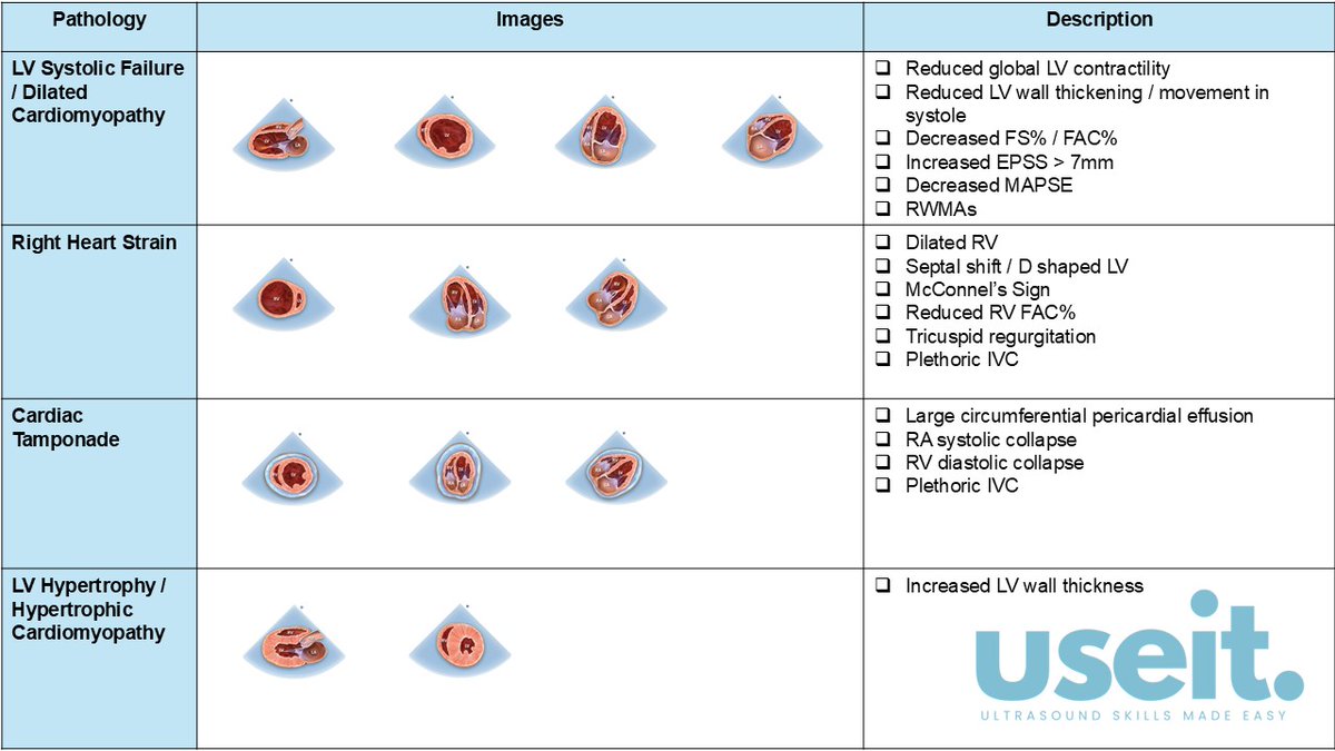 pocus_today's tweet image. #useit #POCUS Focused Cardiac Ultrasound Findings in Common Scenarios