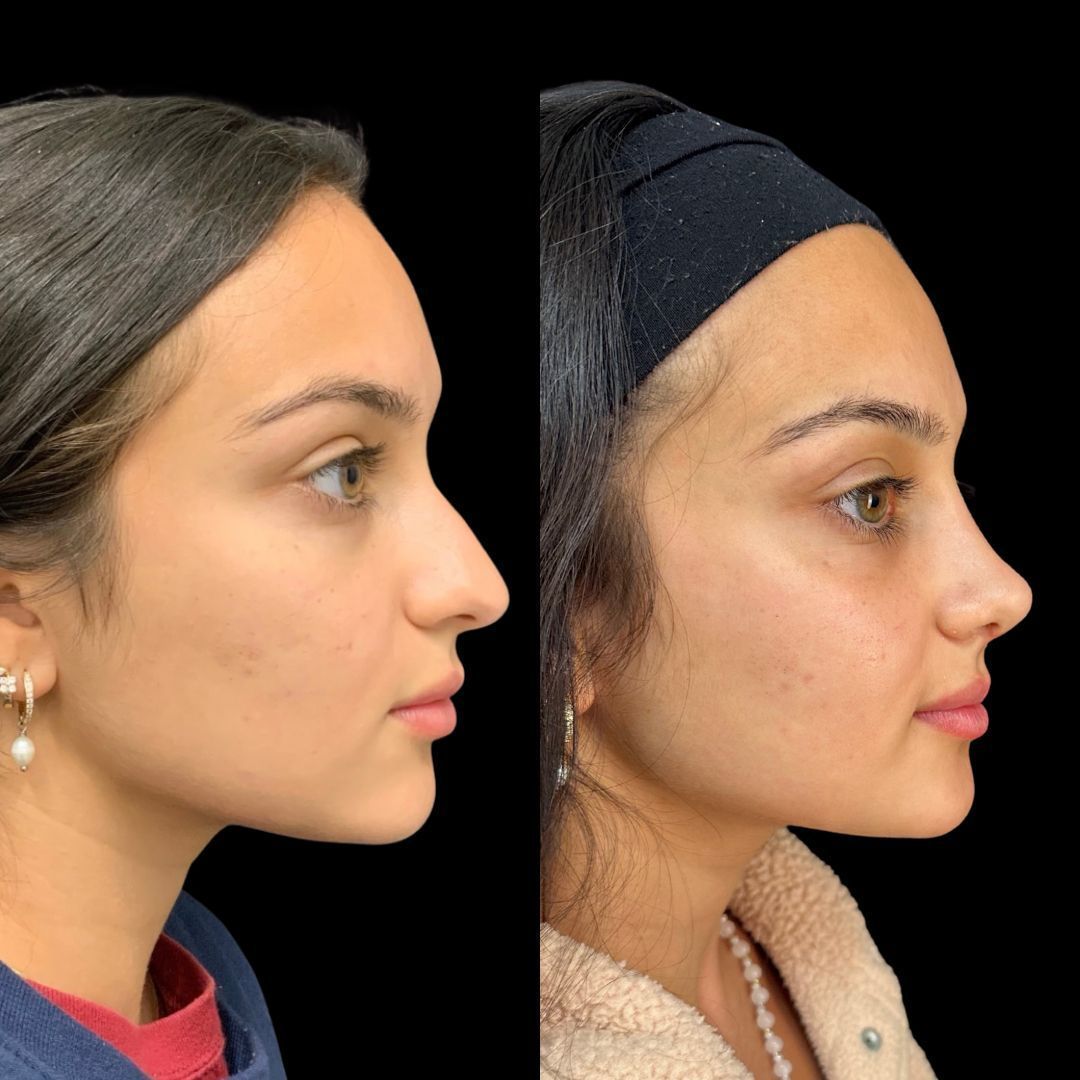RobbJrMD's tweet image. Meet Taraneh!🤩

⭐️ Taraneh is so, so lovely and naturally gorgeous!

She wanted her nose to fit her face! She did not like her hump and felt it was too big.

These results are at just 1 month post-op — still early healing, still swelling, but already such a harmonious profile!