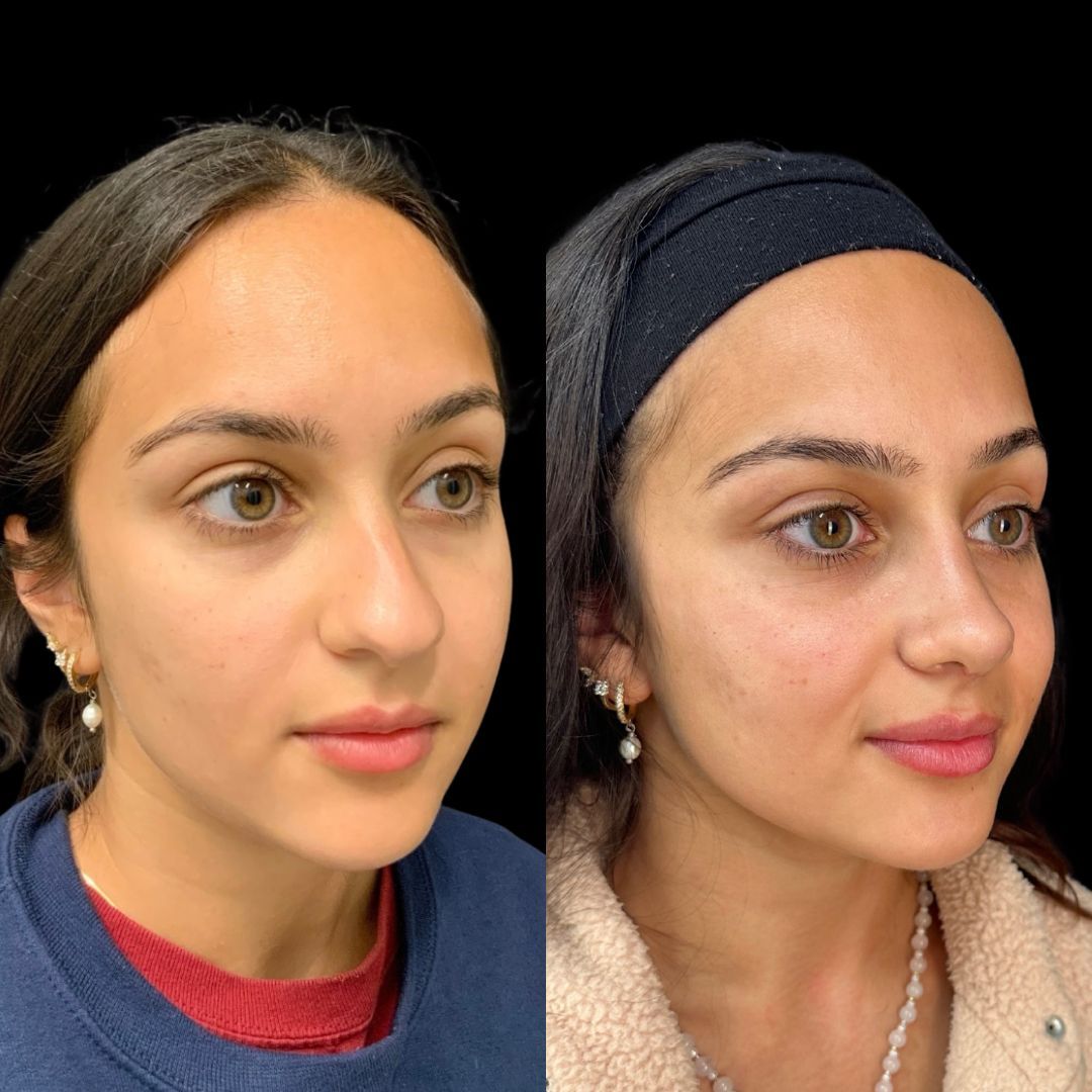 RobbJrMD's tweet image. Meet Taraneh!🤩

⭐️ Taraneh is so, so lovely and naturally gorgeous!

She wanted her nose to fit her face! She did not like her hump and felt it was too big.

These results are at just 1 month post-op — still early healing, still swelling, but already such a harmonious profile!